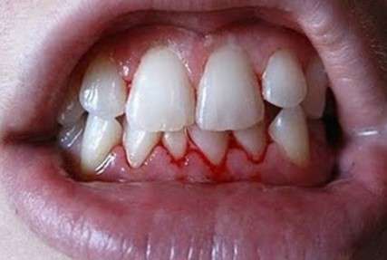Bleeding gum, Know causes & treatments