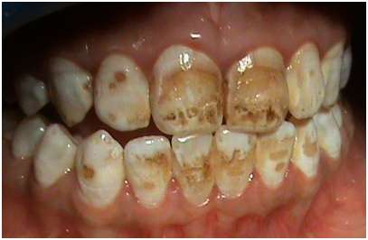 Tooth Stain or Discoloration