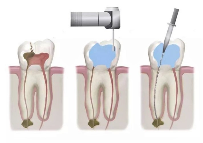 Root canal treatment or RCT