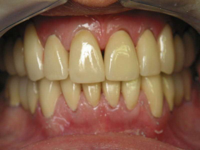 Yellow-teeth-cause-prevention-treatment