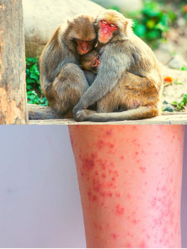 Monkey pox- Causes, Spread, Sign & Symptoms