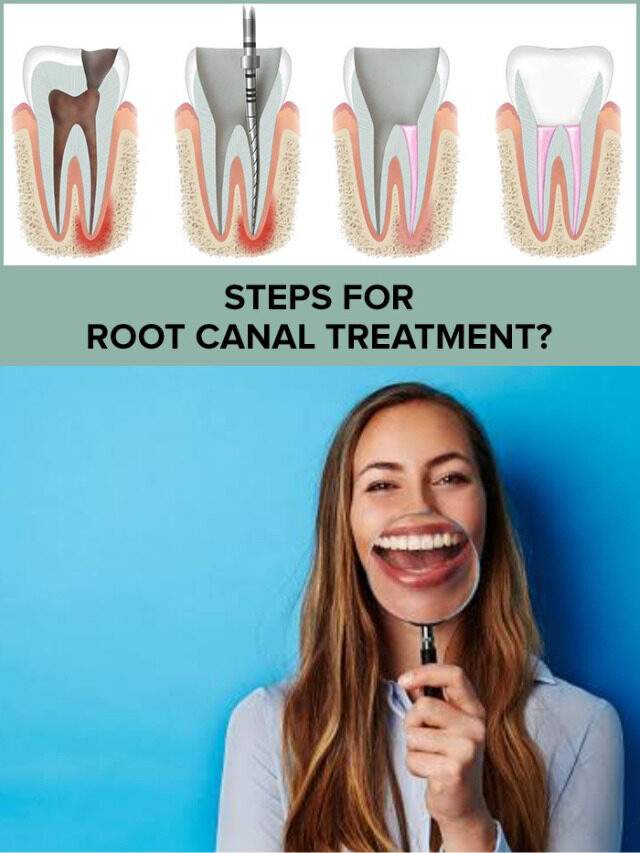 Root Canal Treatment or RCT Indications