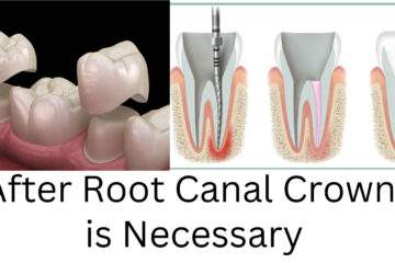 After Root Canal Crown