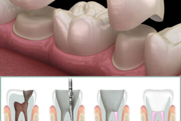 After Root Canal Crown is very important