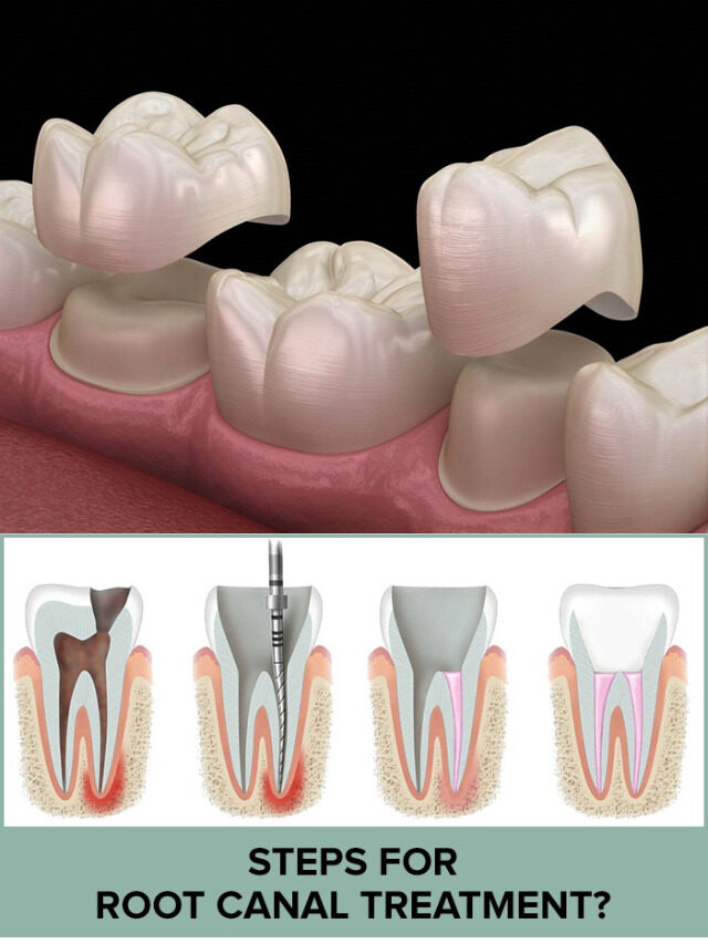 After Root Canal Crown is very important