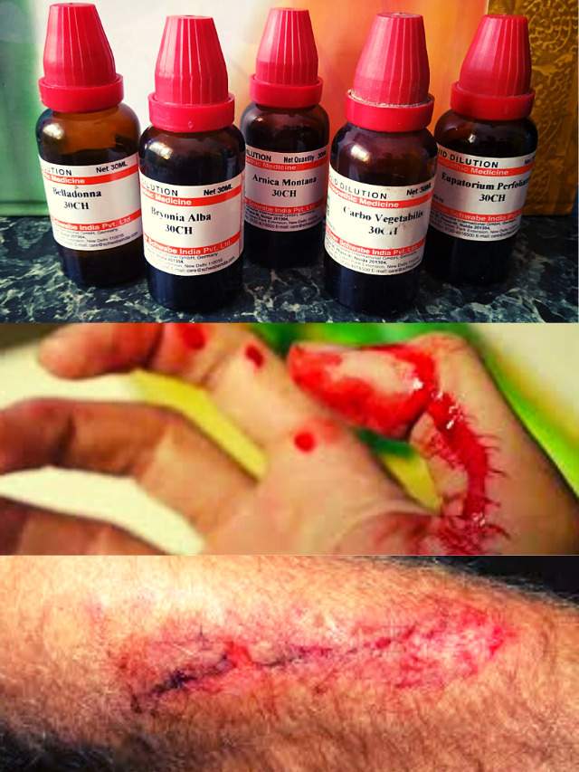 Homeopathy Medicine for Cut, Burn, Trauma & Wound