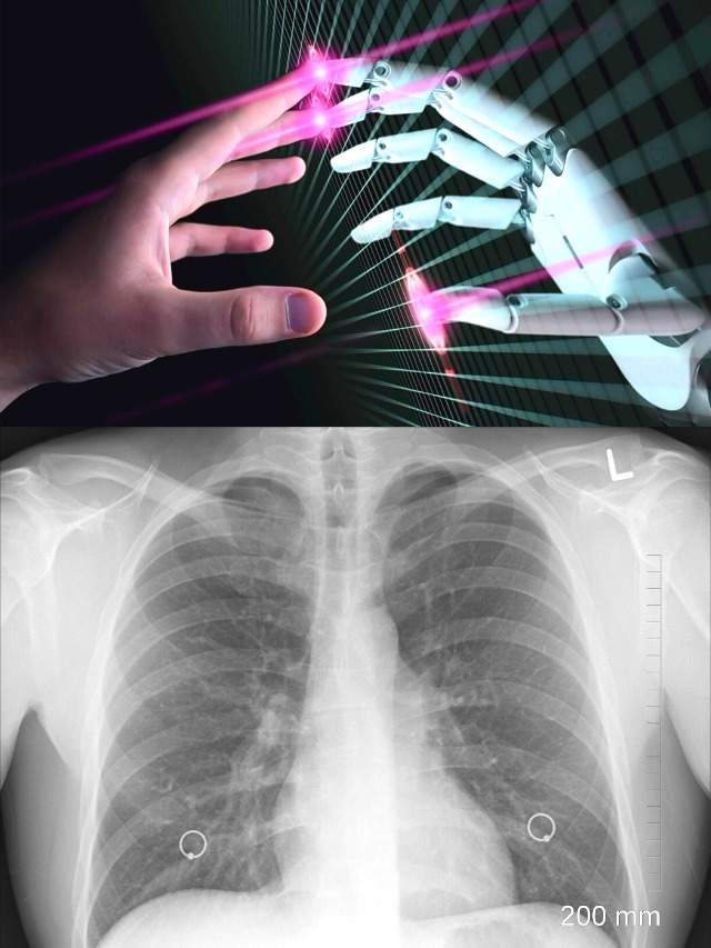 Robotic Technology help to find & Treat Lung Cancer