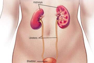 Symptoms of Urinary tract infection or UTI